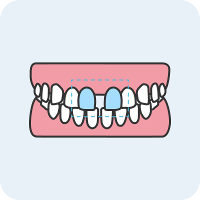 空隙歯列(すきっ歯)とは？