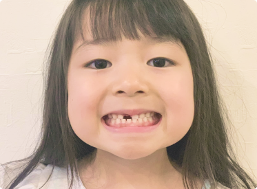 6歳頃から始まる生え変わりのサイン