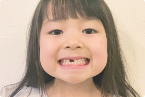 乳歯は永久歯に影響しないよう慎重に対応