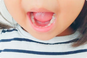 麻酔が効いている間に注意してほしいこと